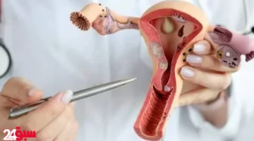 تكيس المبايض ونزوله مع الدورة.. علامات تكشف حقيقة شكله وكيف تلاحظينه